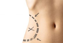 Kawitacja ultradźwiękowa – w redukcji nadmiaru tkanki tłuszczowej