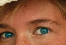 Ocena zmian barwnikowych i metody ich usuwania