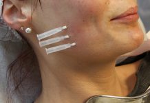 Polidioksanowe nici liftingujące – nowość w medycynie estetycznej