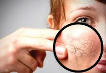 Trądzik pospolity w praktyce