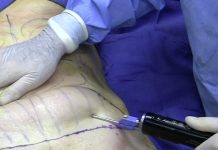 Liposukcja jako zabieg chirurgii kosmetycznej