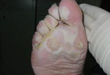 Skuteczna ochrona przed grzybicą stóp Co warto wiedzieć?