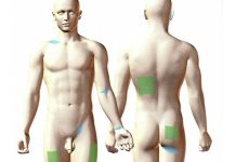 Rany oparzeniowe Cz. 1 Przeszczepy skóry jako metoda leczenia ran oparzeniowych