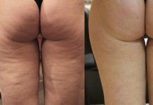 Cellulit – problem z pogranicza medycyny i kosmetologii