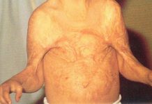 Rany oparzeniowe. Część 2. Postępowanie pooperacyjne