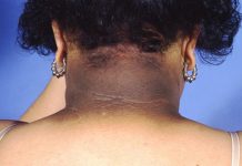 Najczęstsze problemy dermatologiczne w otyłości