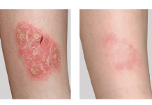 Łuszczyca – leczenie zewnętrzne