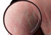 Dermokosmetyczna pielęgnacja skóry z azs i łuszczycą