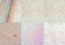 Ocena stanu cery suchej po zastosowaniu serii zabiegów z kwasem migdałowym