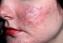Diagnostyka i pielęgnacja skóry z trądzikiem różowatym