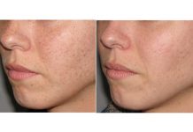 Przebarwienia skóry. Etiologia i leczenie za pomocą lasera