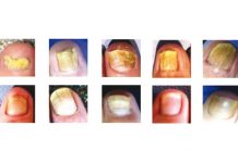 Laseroterapia w leczeniu grzybicy paznokci. Wstępny raport z prowadzonej próby klinicznej