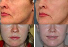 Leczenie przebarwień. Przegląd metod