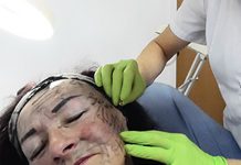 Indywidualne programy anti-aging – Nici polidioksanowe (PDO)