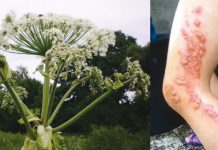 Fotodermatozy – ,,uczulenia na słońce”