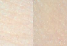 Zastosowanie mezoterapii w celu poprawy estetyki twarzy, ze szczególnym uwzględnieniem komórek macierzystych