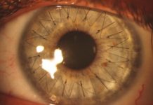 Pełzakowe zapalenie rogówki jako powikłanie nieprawidłowego używania soczewek kontaktowych