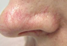 Trądzik różowaty leczenie i pielęgnacja w gabinecie dermatologicznym i kosmetycznym