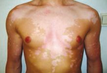 Wpływ chorób tarczycy na skórę