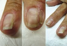 Rogowacenie kanalikowate paznokci