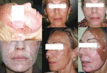 Pielęgnacja i regeneracja skóry po nieinwazyjnych zabiegach odmładzania twarzy