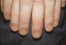 Wpływ stanu zdrowia oraz stylu życia na wygląd paznokci