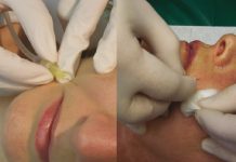 Karboksyterapia w dermatologii estetycznej