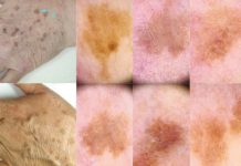 Zapobieganie i sposoby usuwania plam barwnikowych – przegląd dostępnych metod