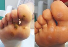 Brodawki wirusowe na stopach – postępowanie podologiczne