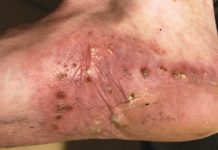 Charakterystyka najczęstszych dermatoz skóry stóp