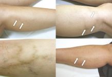 Powikłania po zabiegach zamykania poszerzonych naczyń krwionośnych