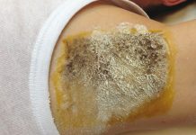 Nadmierna potliwość i jej leczenie