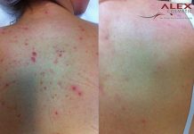 Peeling ziołowy w leczeniu przebarwień skóry