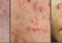 Kosmetologia wobec problemów cery tłustej i trądzikowej