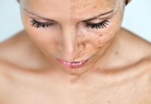 Substancje biologicznie czynne stosowane w rozjaśnianiu hiperpigmentacji skóry