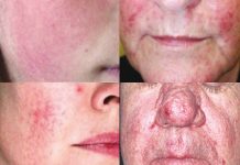 Trądzik różowaty – leczenie oraz pielęgnacja skóry