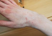 Świerzb – diagnostyka i leczenie