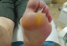 Usuwanie modzeli i hyperkeratozy tyłostopia – techniki podologiczne