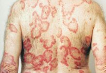 Skórne postacie tocznia rumieniowatego