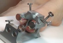 Kostka Arkady jako innowacyjna metoda korekcji wrastających paznokci