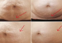 Wpływ zabiegu karboksyterapii na redukcję rozstępów w okolicy brzucha – opis przypadku