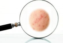 Laseroterapia w redukcji blizn o różnej etiologii – przegląd literatury