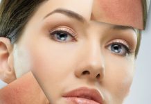 Charakterystyka i redukcja zmian naczyniowych występujących w obszarze twarzy. Cz. I. Zabiegi nieinwazyjne