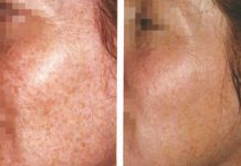 Chemoeksfoliacja – substancje stosowane w peelingach medycznych oraz wskazania do ich stosowania