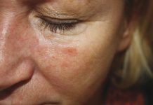 Rogowacenie słoneczne. Wstępna diagnostyka w gabinecie kosmetologicznym