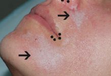 Zastosowanie kwasu trójchlorooctowego TCA w kosmetologii