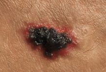 Charakterystyka czerniaka oraz ocena poziomu wiedzy studentów na temat czerniaka złośliwego