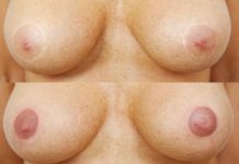 Mikropigmentacja medyczna piersi. Cz. I – Jak ukryć blizny po operacji plastycznej?