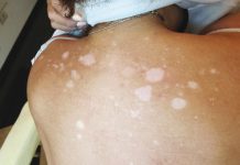 Ukryć bielactwo – mikropigmentacja medyczna