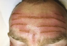 Wpływ zabiegu plazmy na redukcję zmarszczek poziomych czoła. Opis przypadku